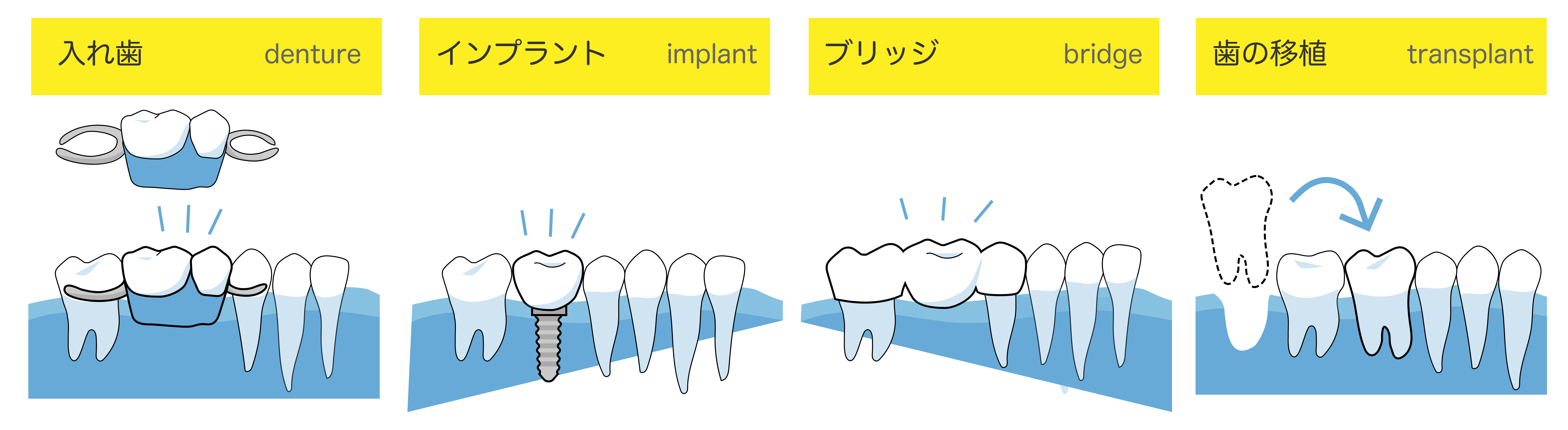 入れ歯、インプラント、ブリッジ、歯の移植　イメージ画